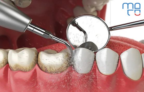 جرم دندان چیست و چرا باید آن را برطرف کنیم؟